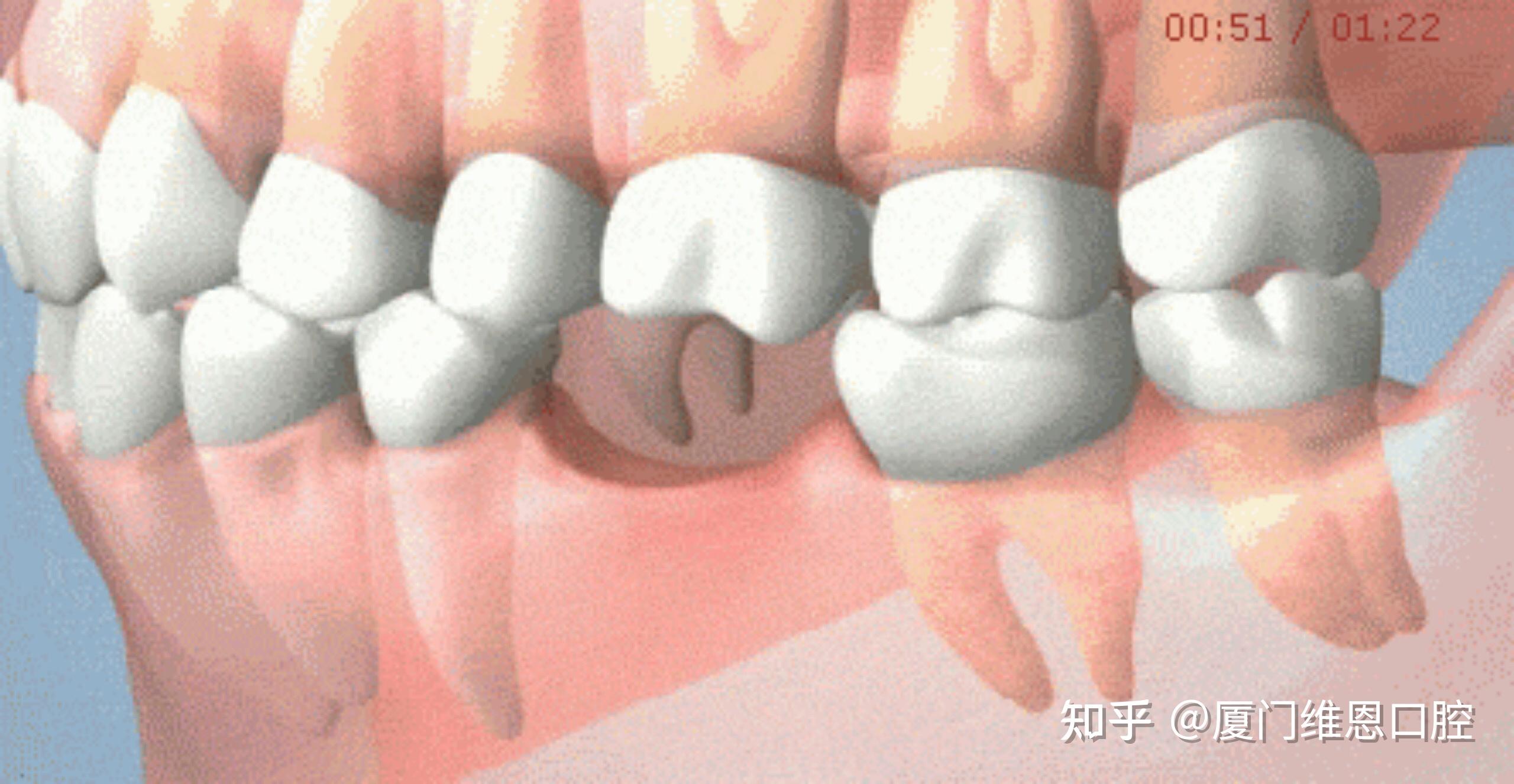假牙材質5臨床案例---上門牙咬斷（磨牙的危害）兼論缺牙區的處理
