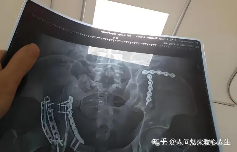 脊髓损伤分级ASIA量表 - 知乎