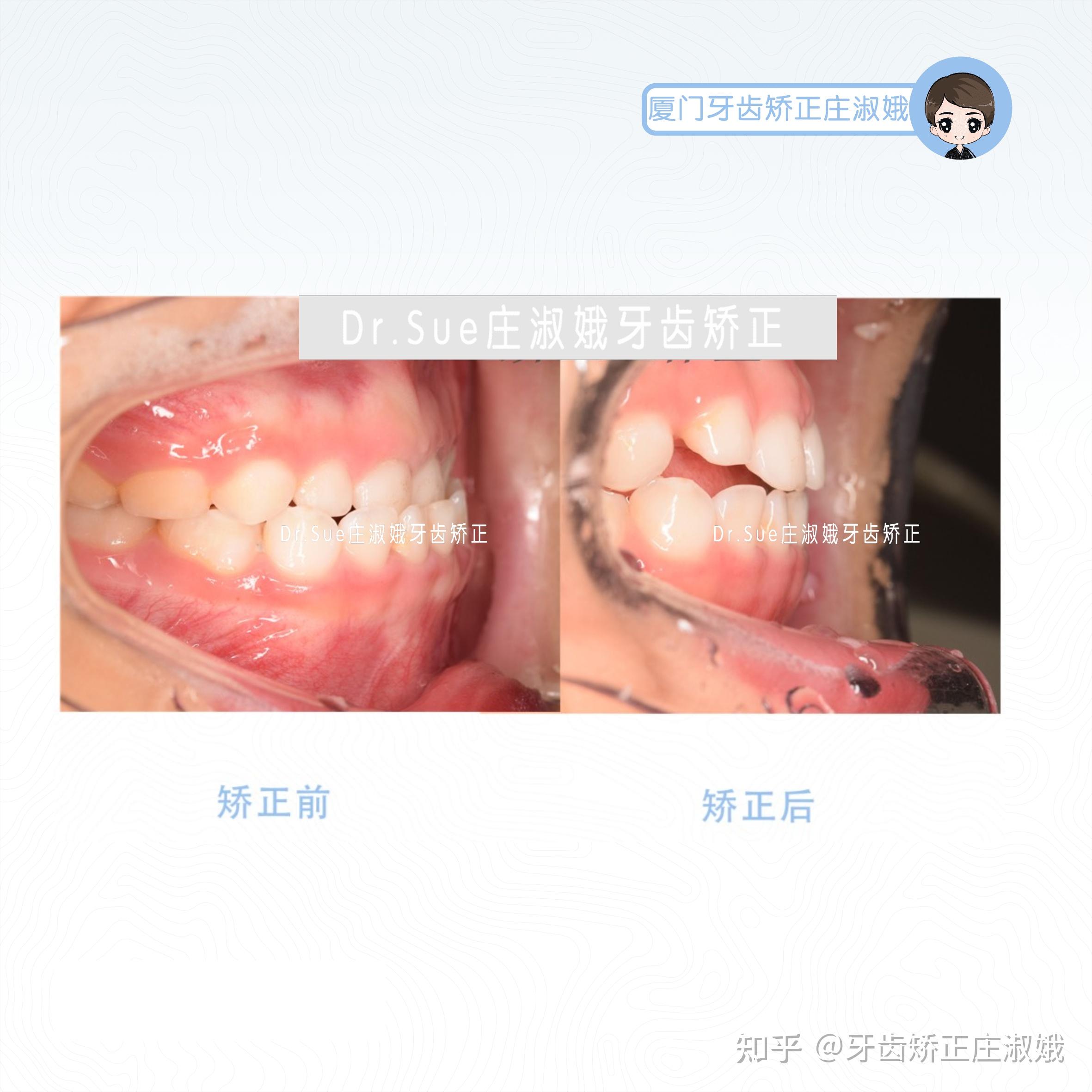 牙齿矫正反颌矫正术_牙齿矫正反颌多少钱_反颌牙齿矫正