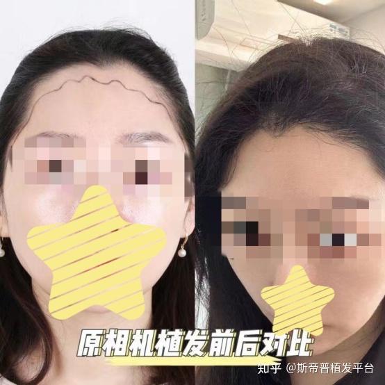 上海植发团购网(上海植发团购网站推荐)