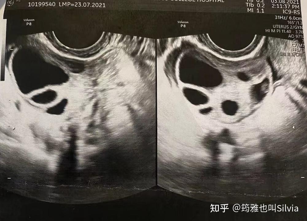 卵巢囊肿输卵管积水一波三折的海外腹腔镜手术