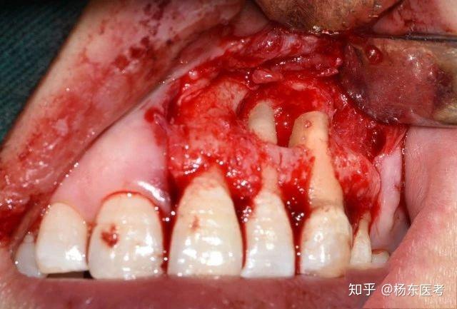 图解根尖手术一例既精彩又新颖的病例报告