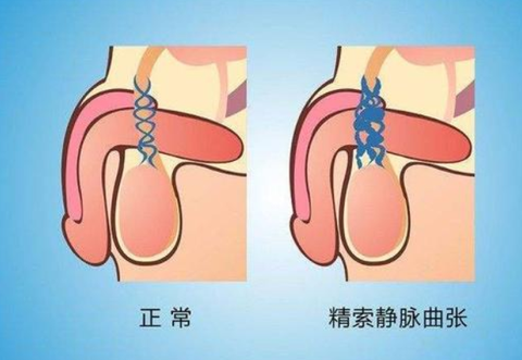 精索靜脈曲張如何自我檢查