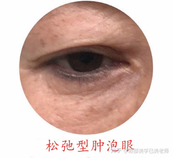 肿泡眼竟是这样的75你属于哪一种7272