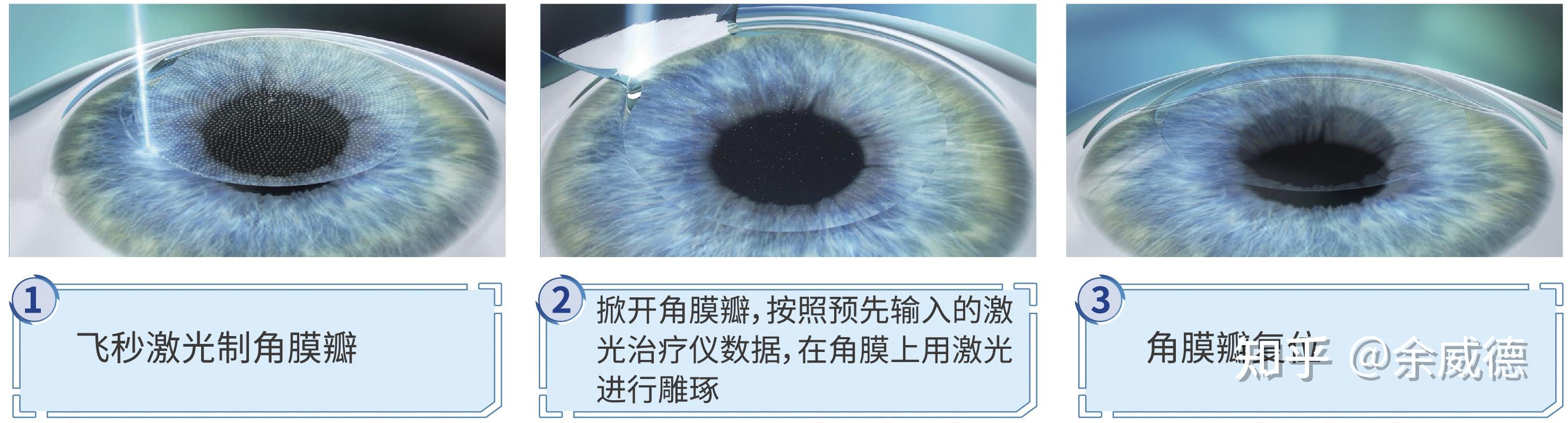 ②半飛秒激光手術(femto-lasik)全飛術前固視訓練視頻(手術室vr)