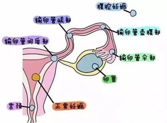 异位妊娠最常见的部位图片