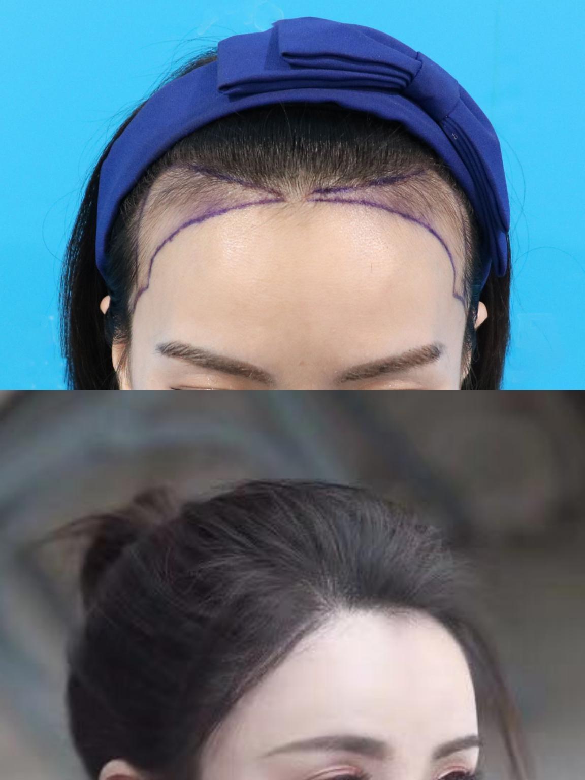 M型脱发发际线植发一年前后对比（真实案例） - 知乎