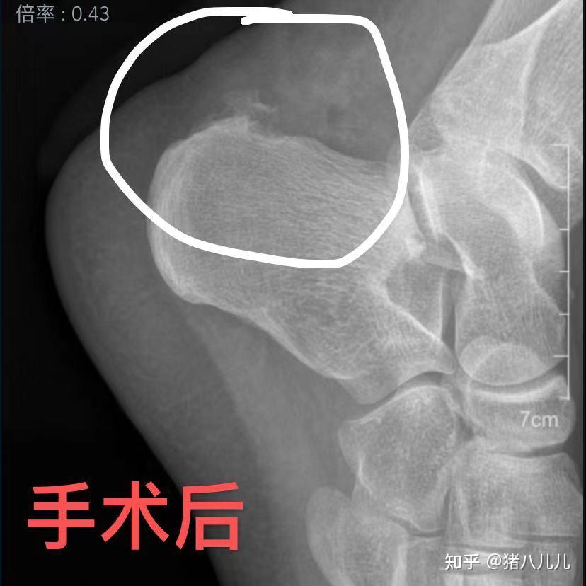 記錄haglund畸形綜合徵跟腱炎手術治療