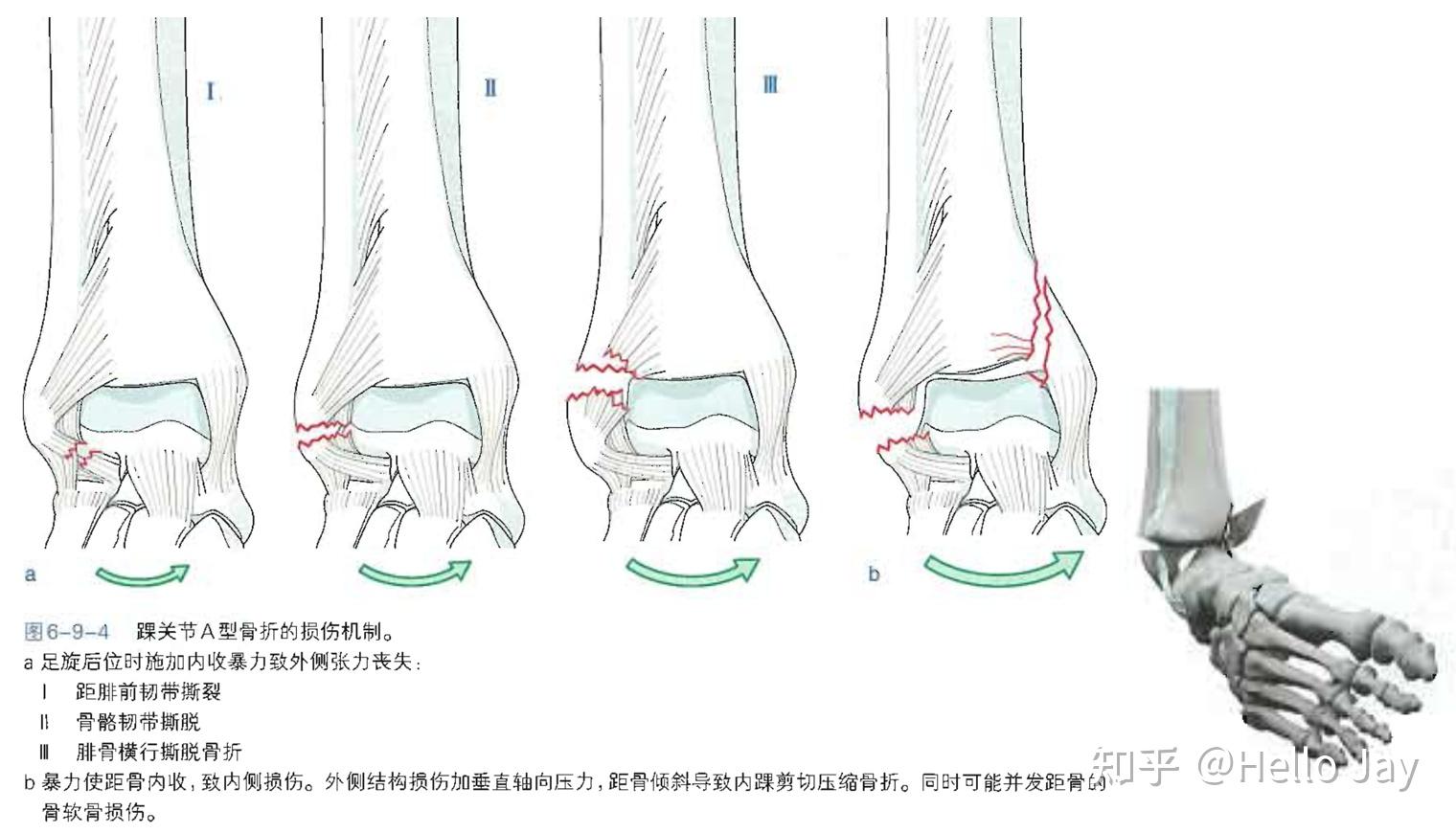 踝关节骨折分型图片图片