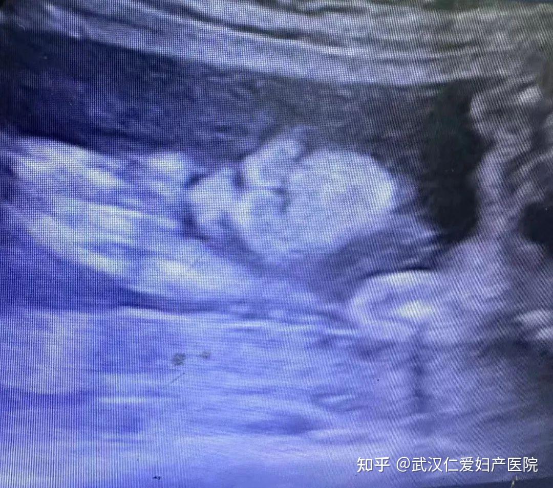 武汉仁爱妇产医院四维彩超精准筛查唇腭裂宝宝