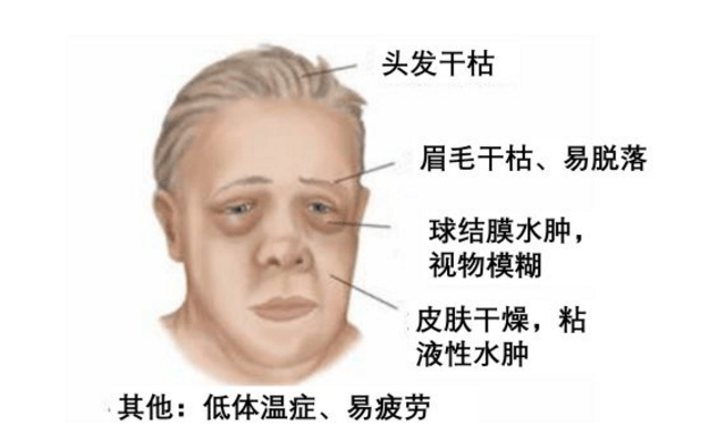 甲减导致患者皮肤干燥,粗糙,为什么?