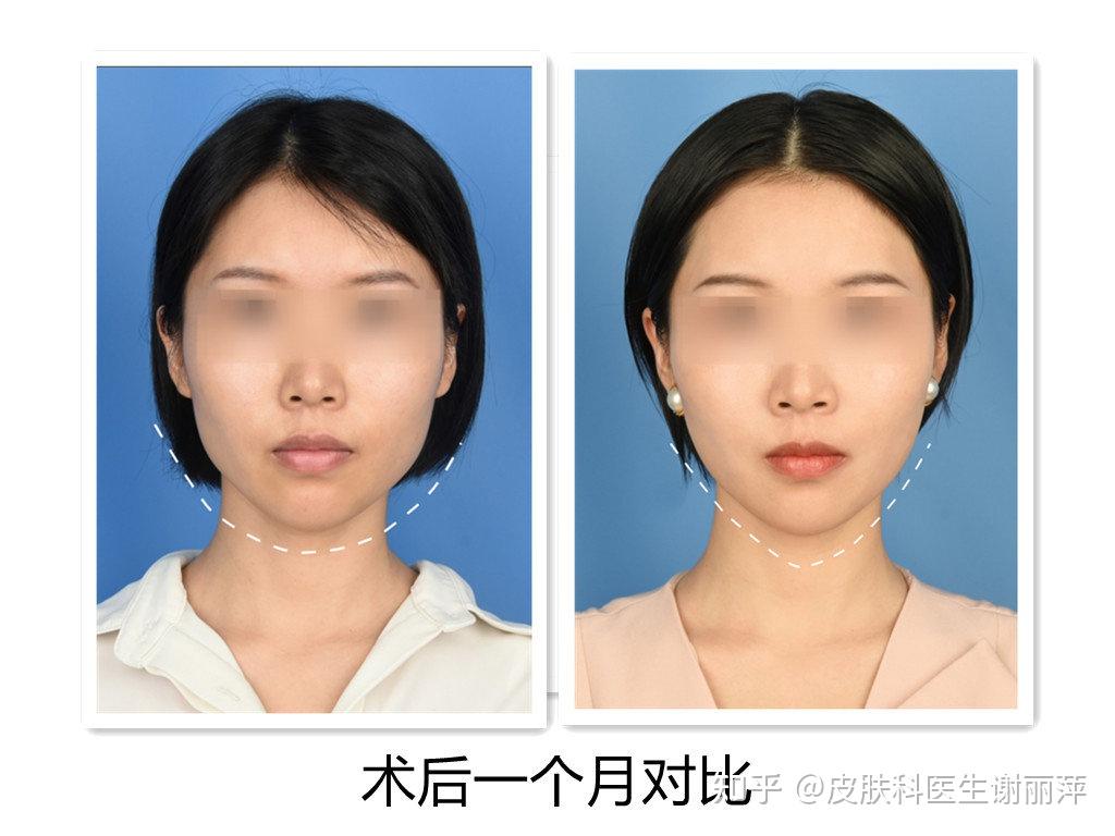 超声炮真人效果对比
