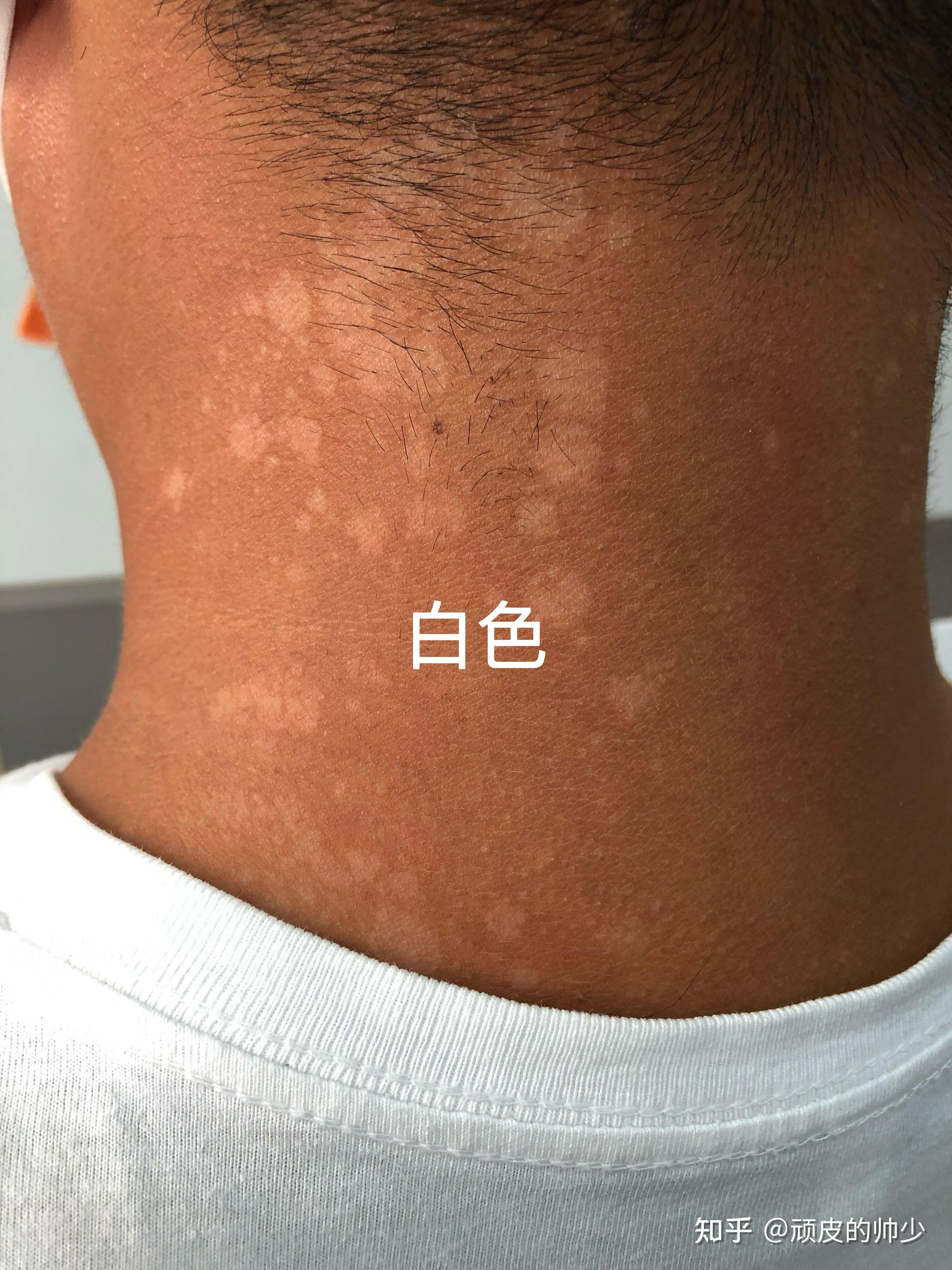 皮膚科王修含醫師: 汗斑的治療原則