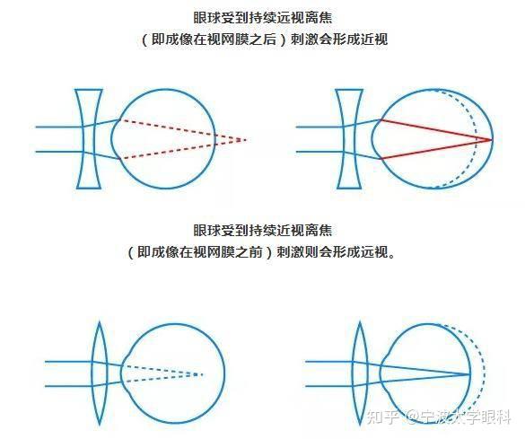 孩子近视,配近视离焦镜是不是离焦量越大越好? - 知乎