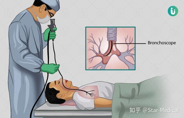 经支气管镜肺泡灌洗术在新冠病毒肺炎诊疗中的应用