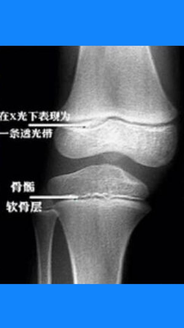 上图x线中骨与骨之间的一道间隔就是骨骺线未闭合前的形态.