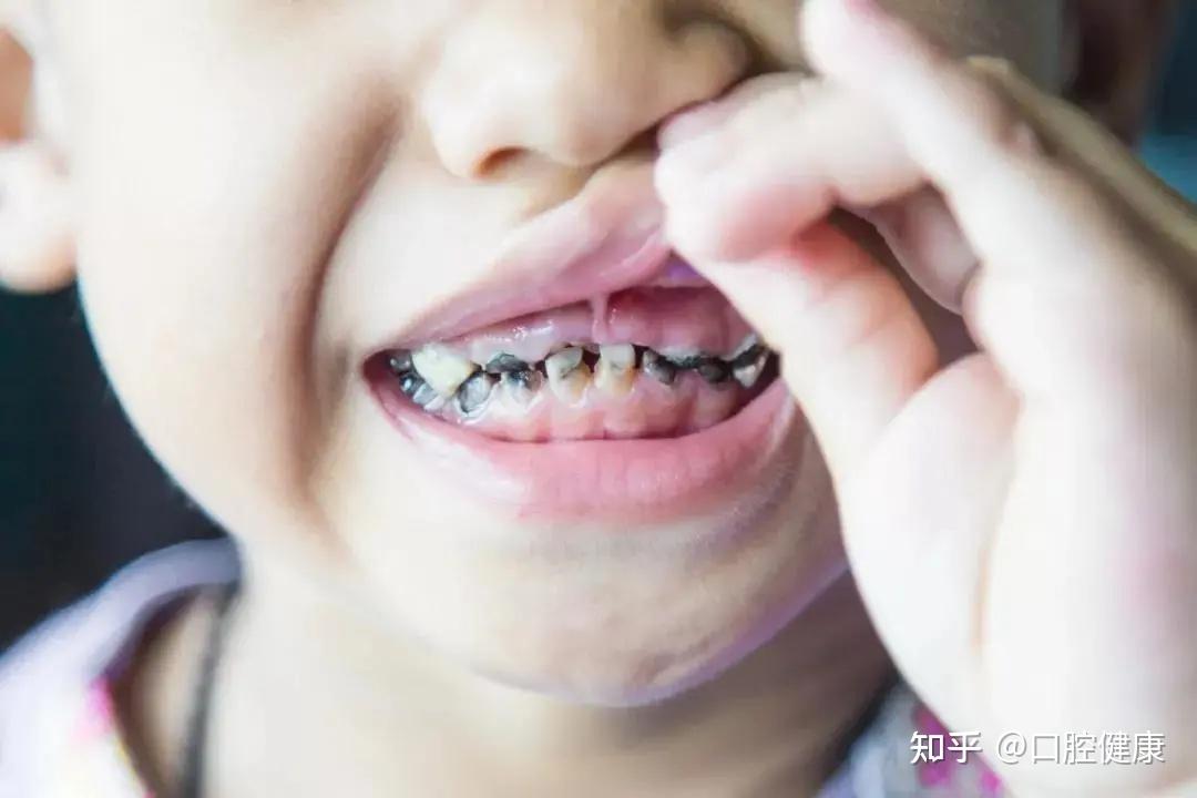 5岁孩子龋齿率高达71毁掉牙齿的不是甜食和饮料而是它们