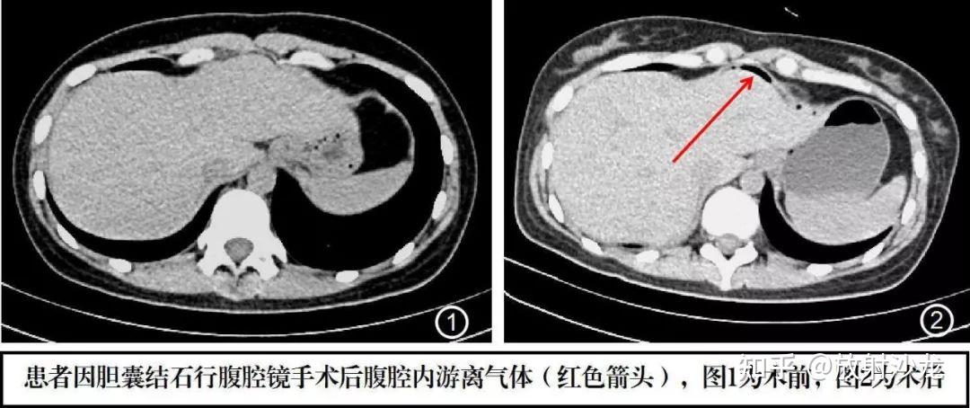 腹腔游离气体ct图像图片