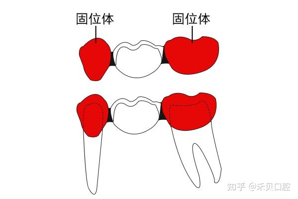 牙齿缺失——固定桥修复! - 知乎