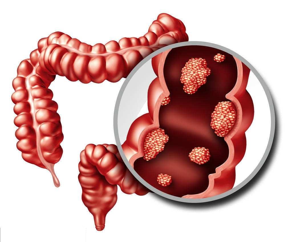 Gut：一例乙状结肠扭转的案例报道 | 消化客-搜狐大视野-搜狐新闻