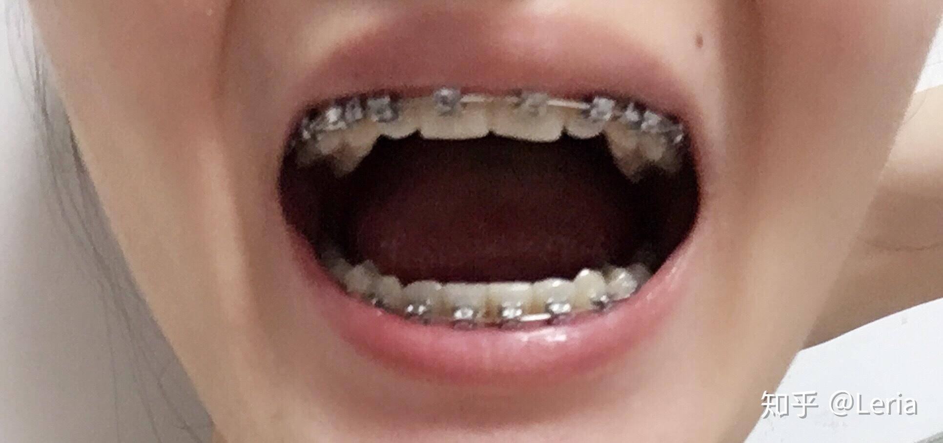 漫漫深覆合牙齿矫正之路记录