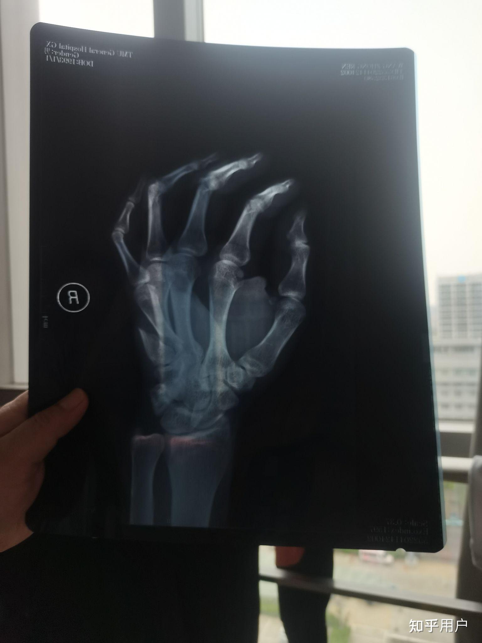 第五手掌骨折做钢板算轻伤吗