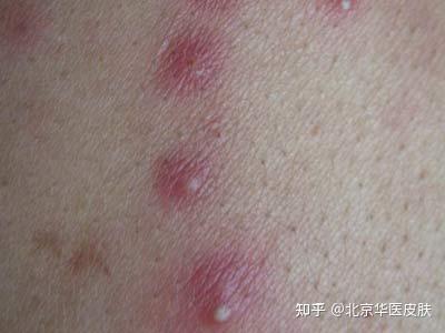 毛囊炎的症状类型 - 知乎