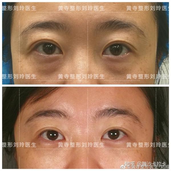眼袋和眶隔脂肪释放手术医生攻略 - 知乎