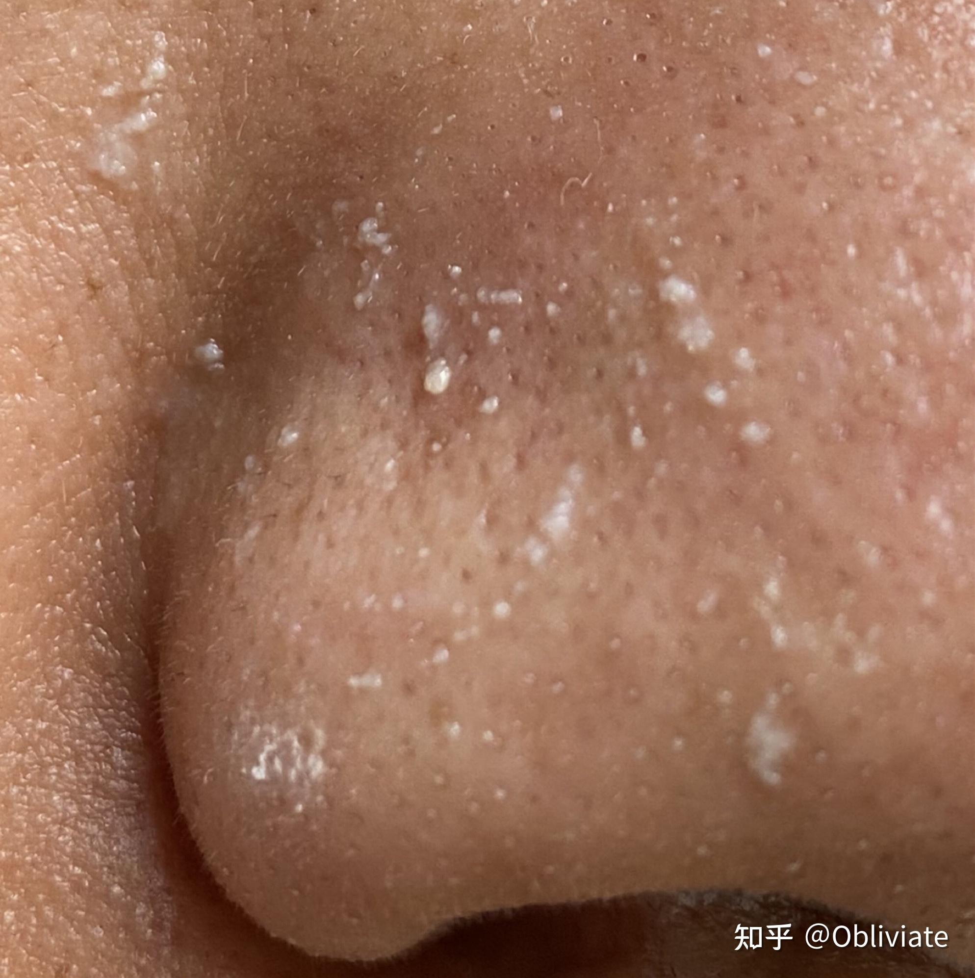 鼻子毛孔里有白色小米粒一样的东西是什么?