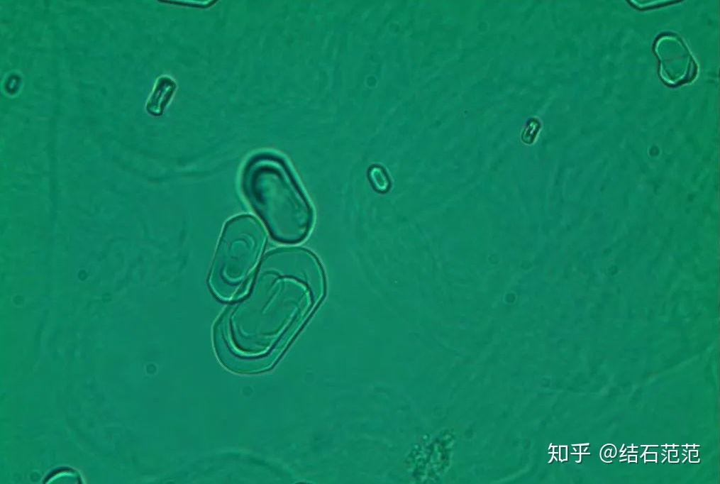 肾结晶体图片