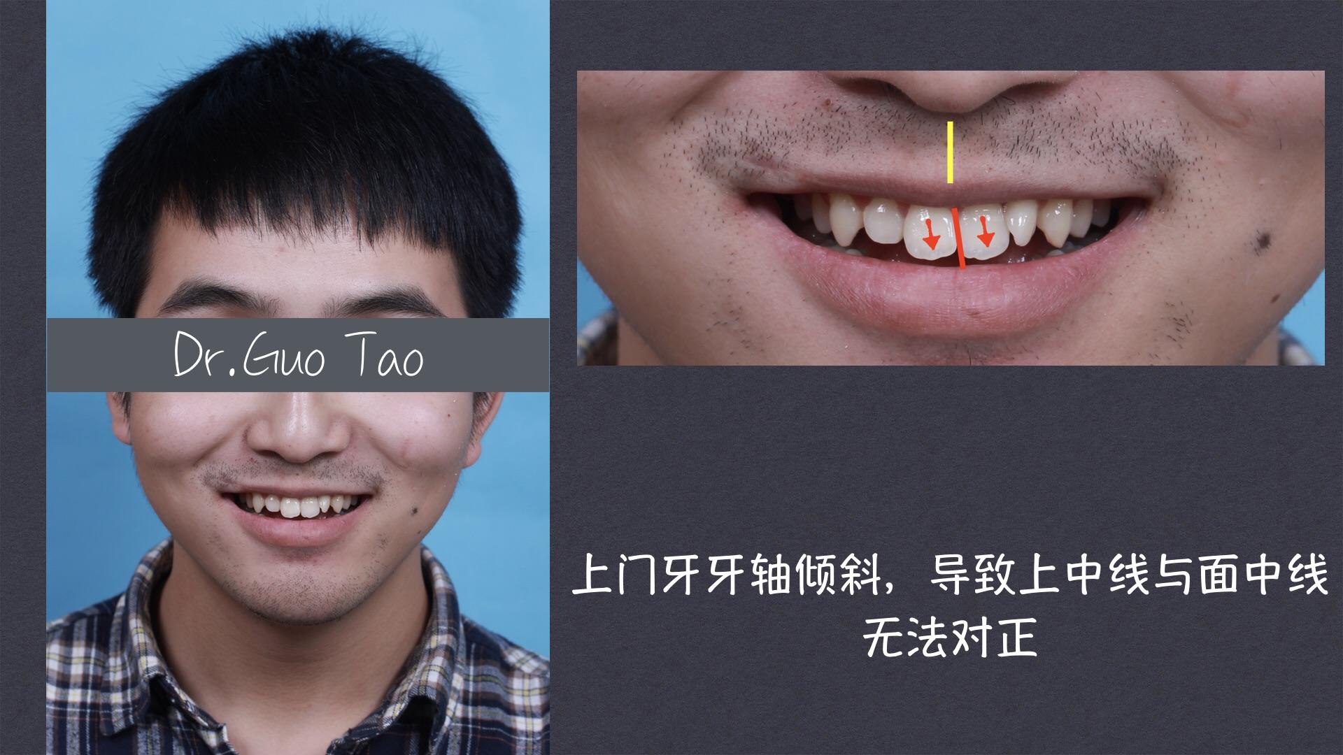 深圳口腔医院|长期缺牙对身体的危害-爱康健齿科