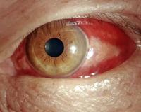 眼底出血最忌酒和辣