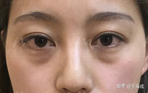 拿掉滤镜一样的年龄不一样的泪沟