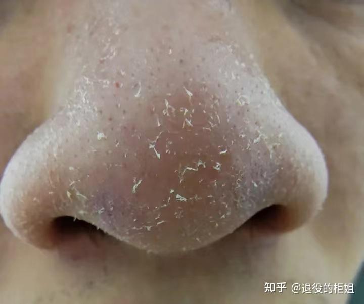 黑头到底能不能挤挤黑头有什么害处