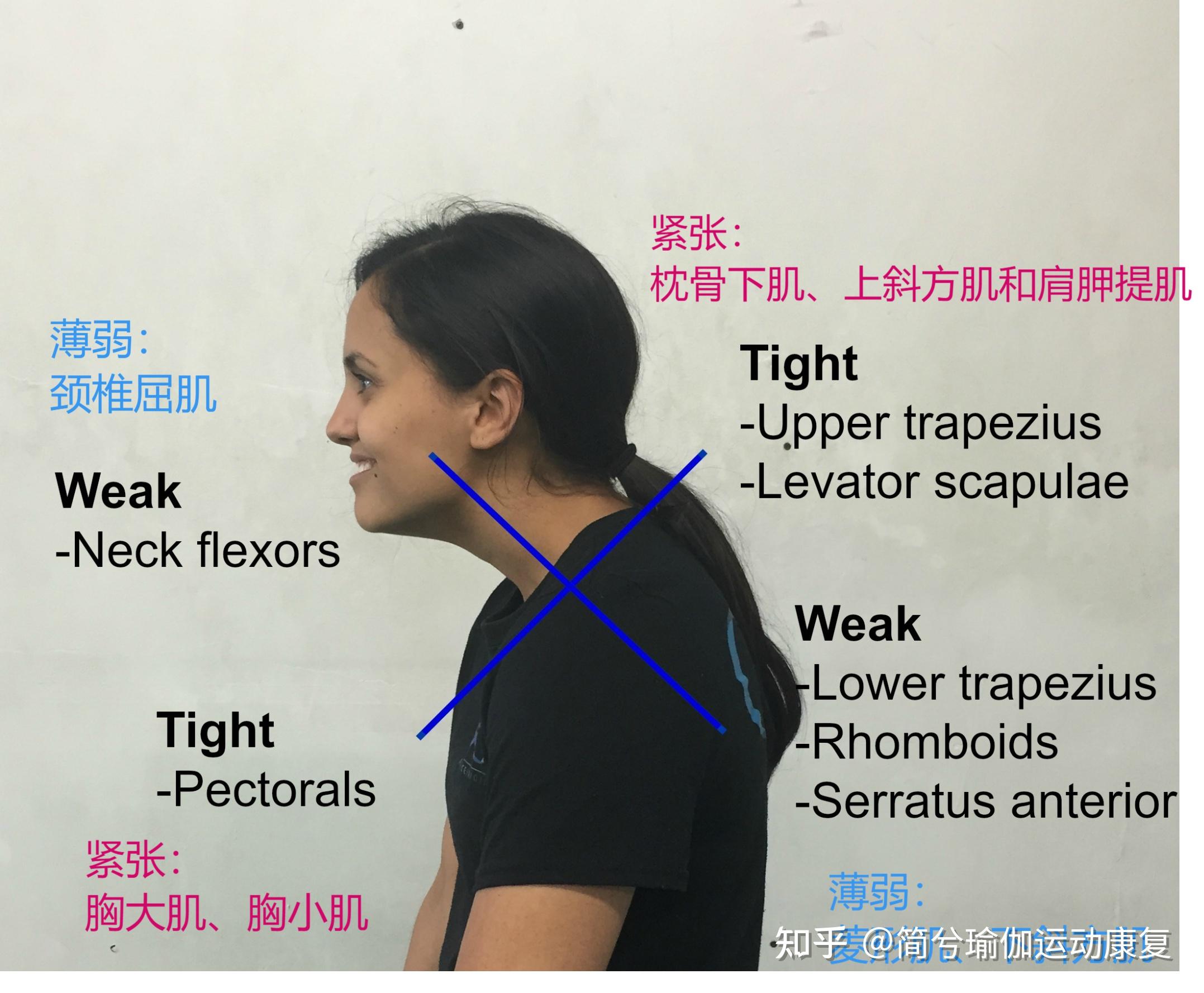 上交叉综合征如何矫正 - 知乎