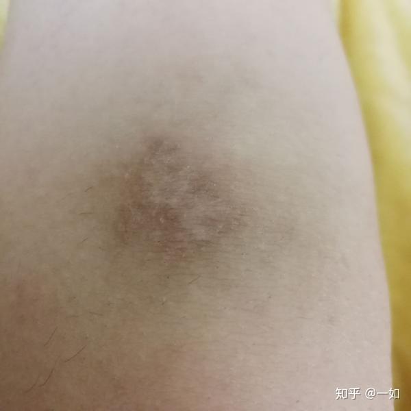 记我的擦伤…