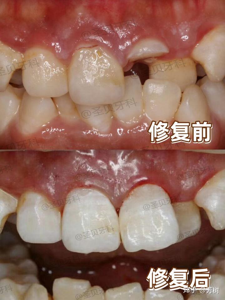 根据实际情况为她选择了根管治疗 自体断牙粘接的治疗方式