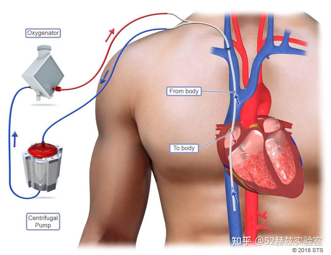 5 ECMO 5-ecmo