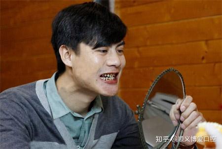 烟渍牙真恶心有什么方法可以快速变白