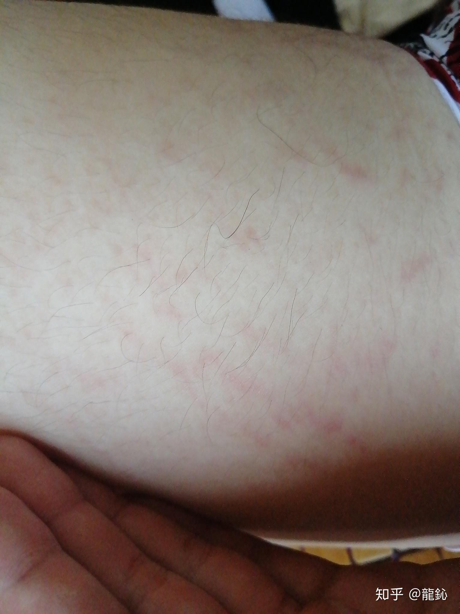 有没有人知道这个我大腿上的纹路红色的是肥胖纹还是生长纹生长纹的话