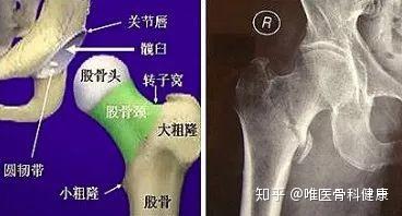 这是老年人最怕的骨折 股骨颈骨折 一定要重视 知乎