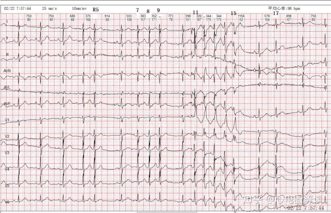 今天要分享的心电图