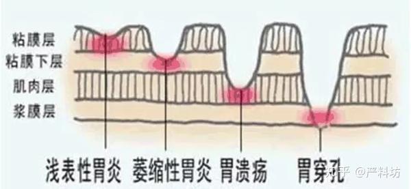 胃部常常反酸烧心怎么办 知乎