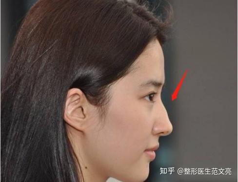 深度解析——驼峰鼻究竟是不是难看鼻型? - 知乎