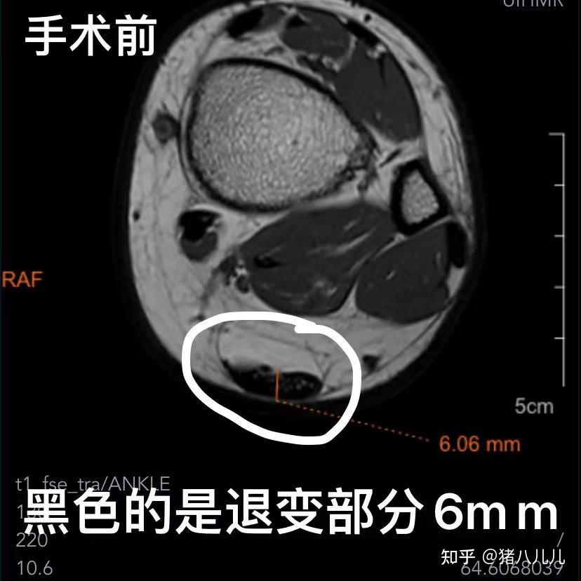 記錄haglund畸形綜合徵跟腱炎手術治療