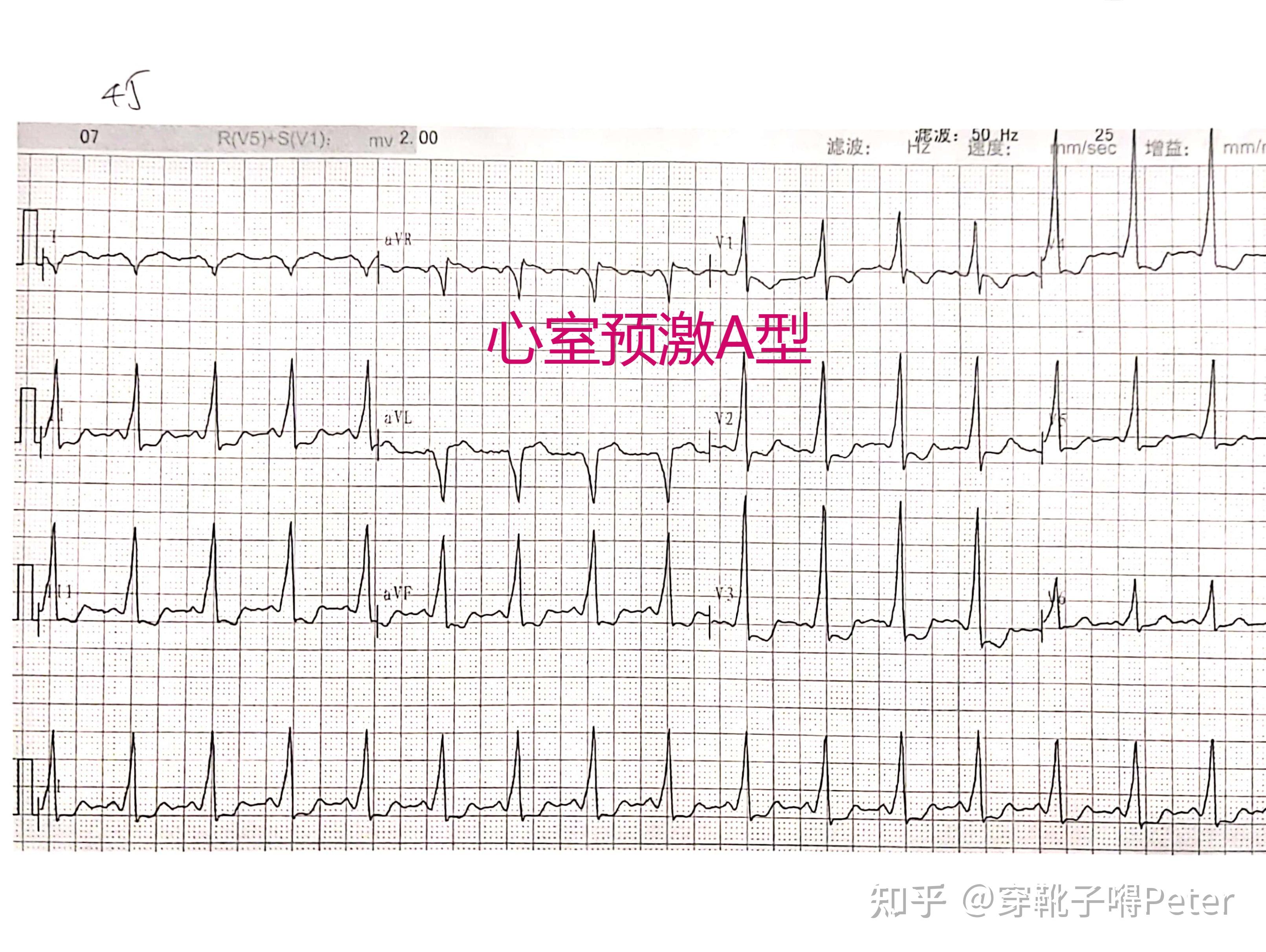 心室预激b型图片