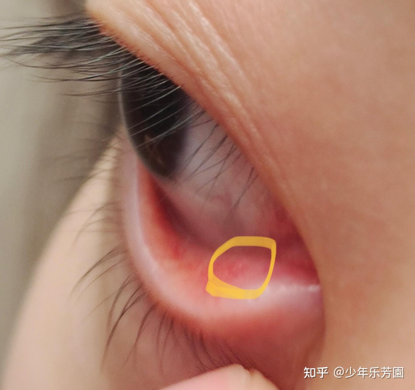 下眼睑长了一个小肉粒