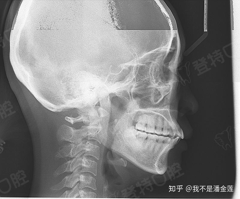 我们可以看到牙齿的数目是否有异常情况(例如:主要是颌骨内有无多生牙