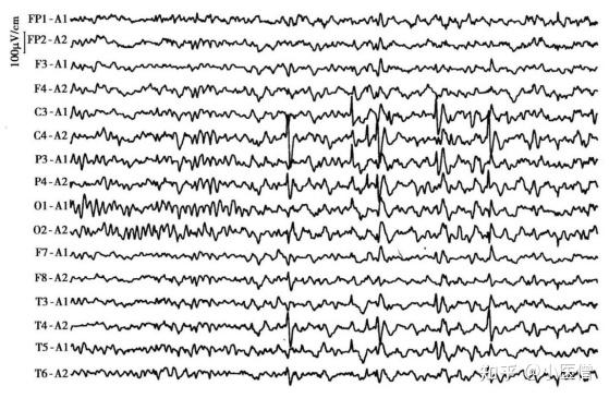 频繁的痉挛发作,脑电图出现高度失律(hypsarrhythmia)和智力发育障碍