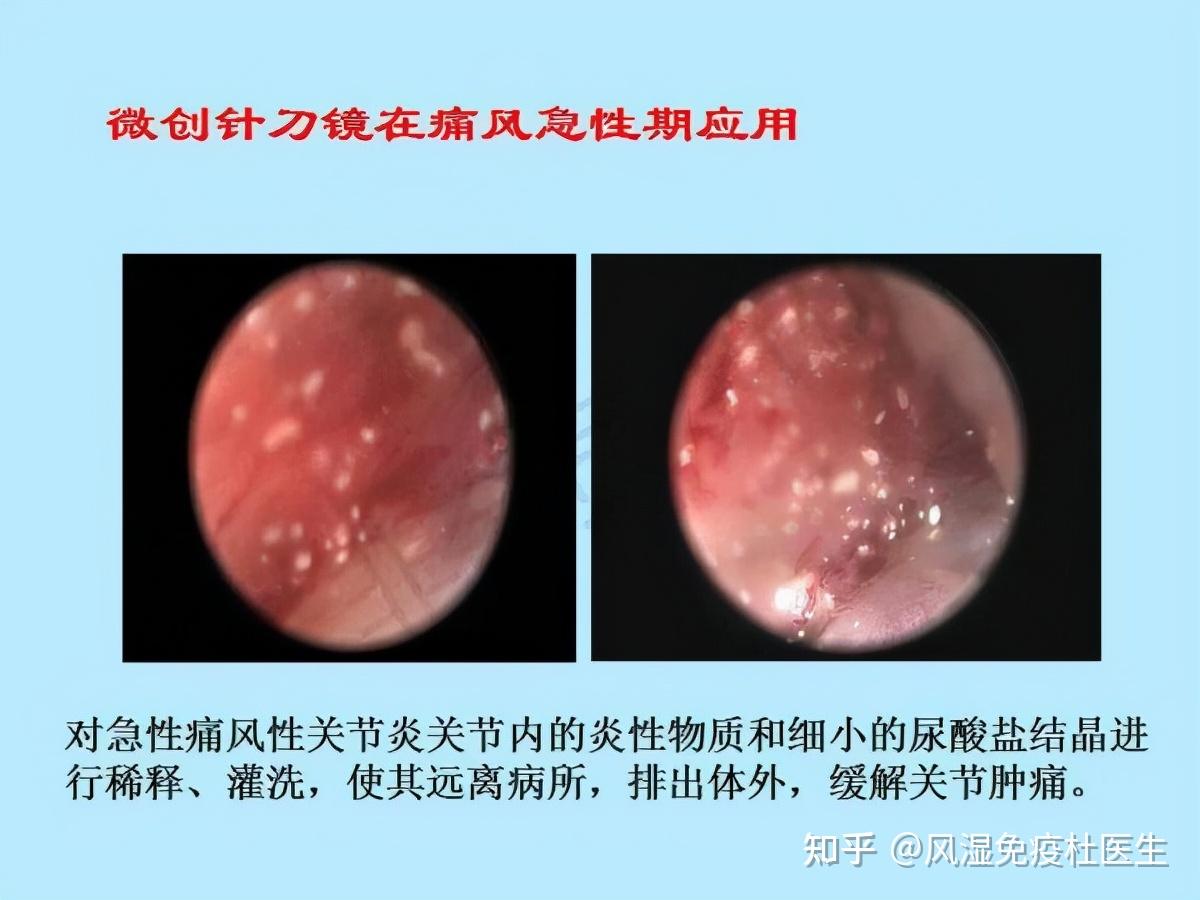 痛風石消除真的難嗎國粹中醫可視針刀鏡半小時即可消除痛風石